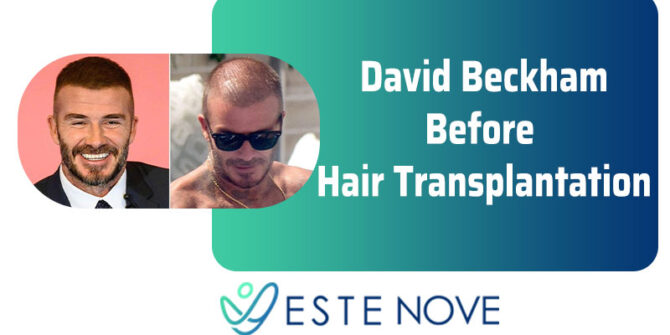 David Beckham Before Hair Transplantation