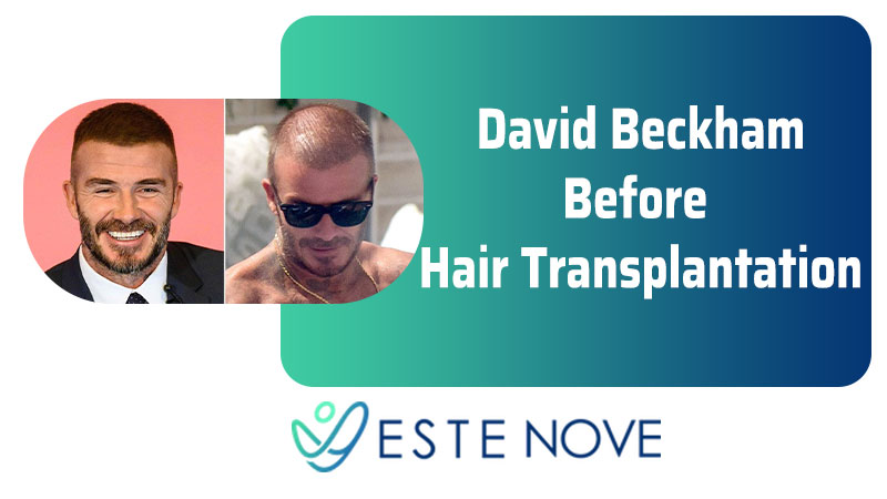 David Beckham Before Hair Transplantation