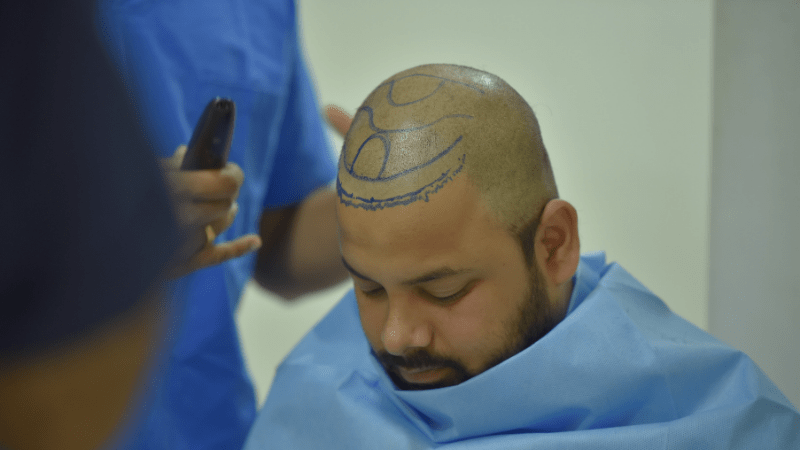 Advantage of FUE