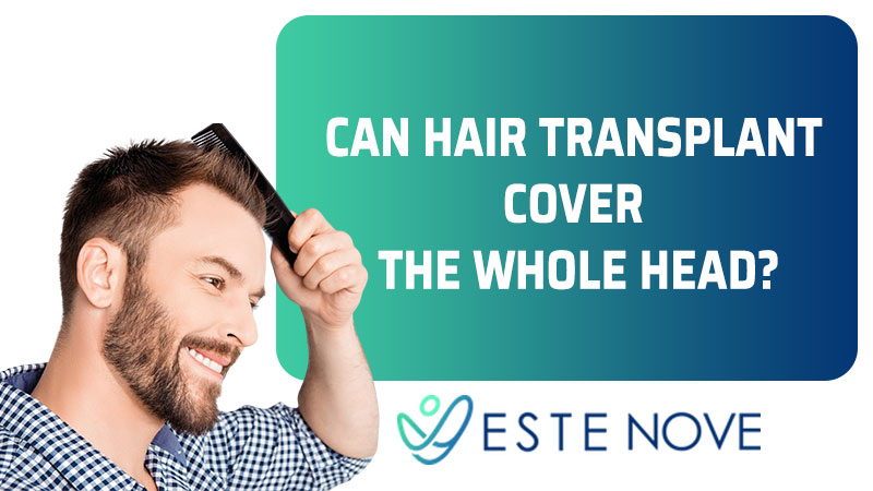 Can Hair Transplant Cover The Whole Head ?