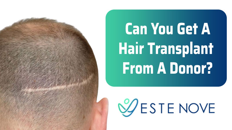 Can You Get A Hair Transplant From A Donor?