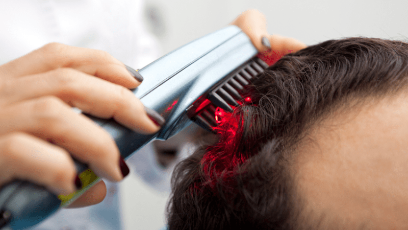 Does Laser Hair Transplant Work