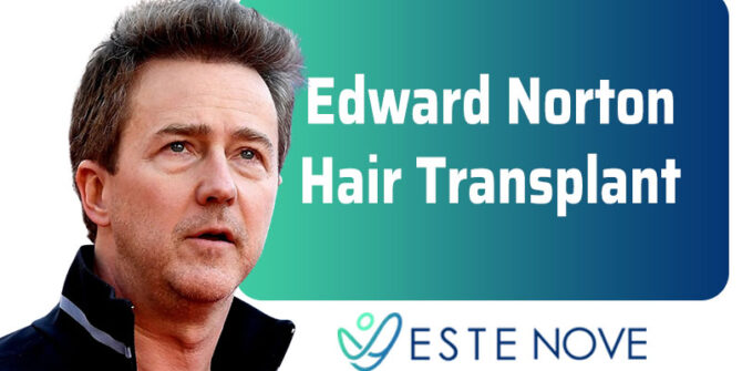 Ed Norton Hair Transplant