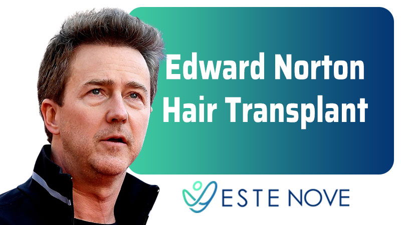 Ed Norton Hair Transplant