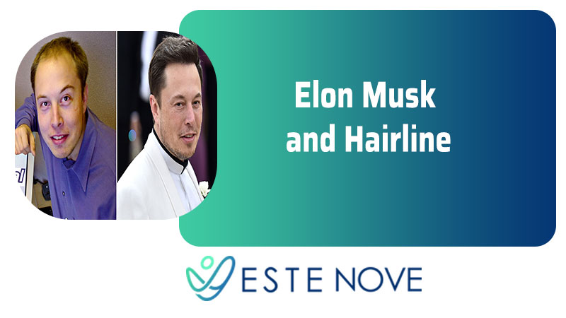 Elon Musk and Hairline