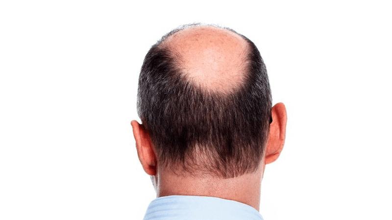 Hair Loss at Nape of Neck - Estenove
