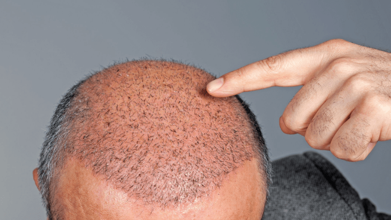 Hair Transplant for Different Hair Types
