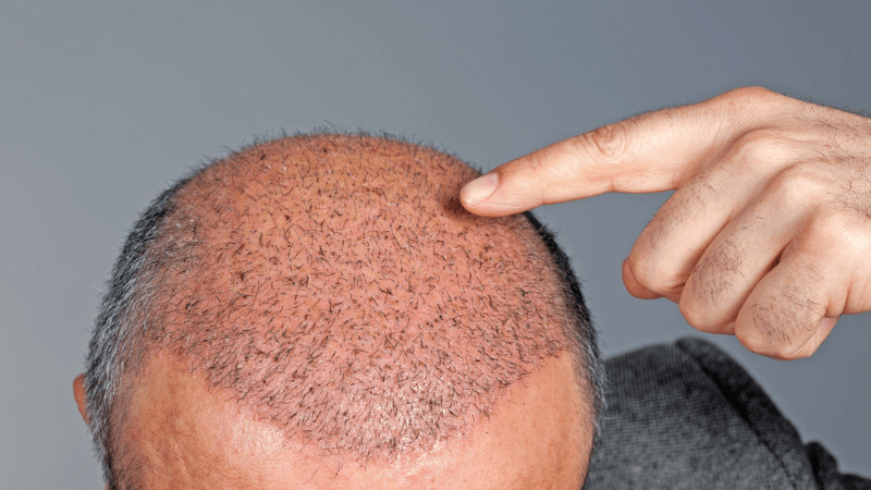 Hair Restoration Injections