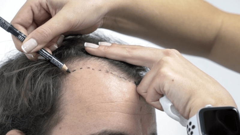 How Much Does It Cost for Hair Transplantation