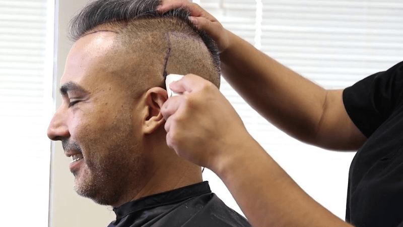 How to Prepare the for FUE Method