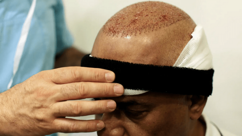 Is Sweating Bad After Hair Transplant? - Estenove