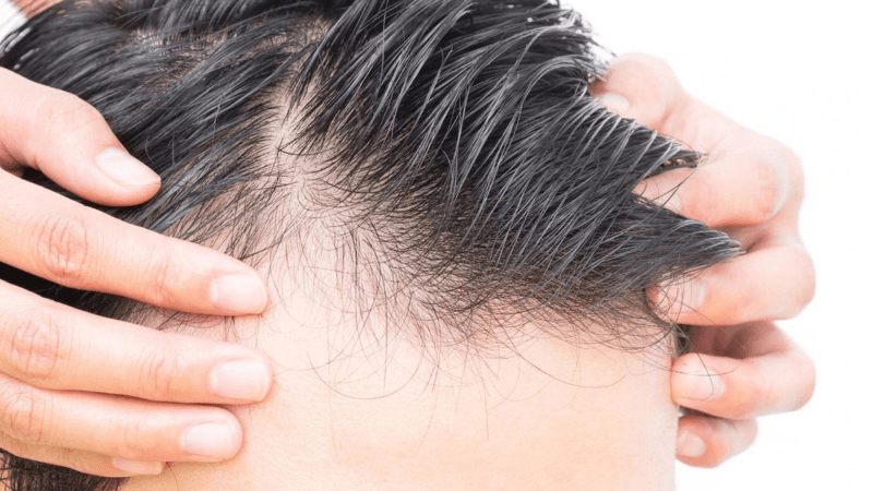 Management of Hair Loss
