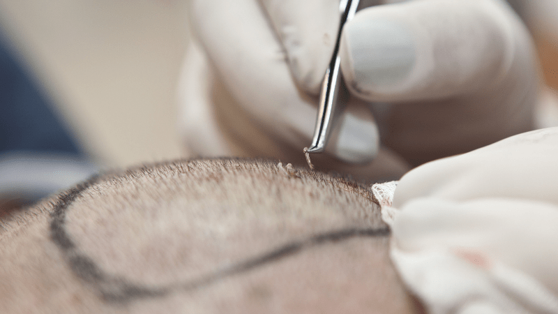 Ten Factors That Affect the Cost of Your Hair Transplant Surgery