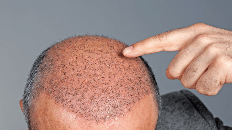 What Age To Get Hair Transplant Operation