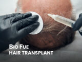 Close-up of a Bio FUE hair transplant procedure showing the extraction of hair follicles.