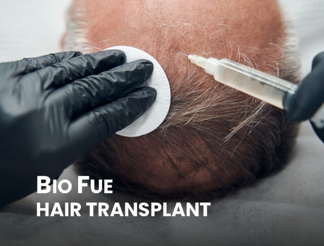 Close-up of a Bio FUE hair transplant procedure showing the extraction of hair follicles.