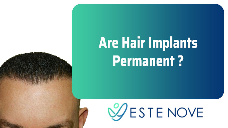 Are Hair Implants Permanent?