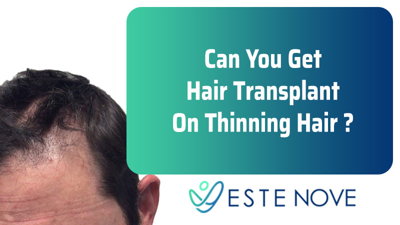 Can You Get Hair Transplant On Thinning Hair - Estenove
