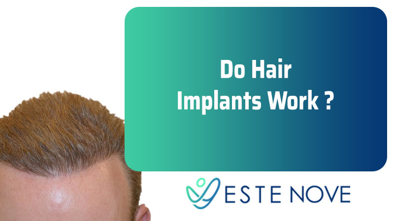 Do Hair Implants Work