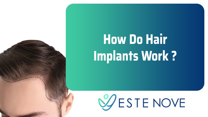 How Do Hair Implants Work