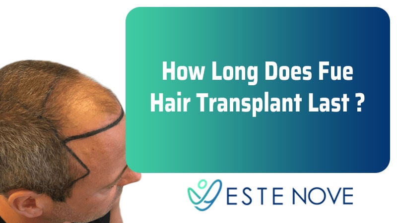 How Long Does Fue Hair Transplant Last