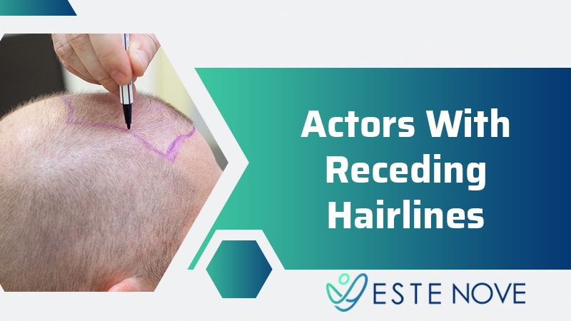 Actors With Receding Hairlines