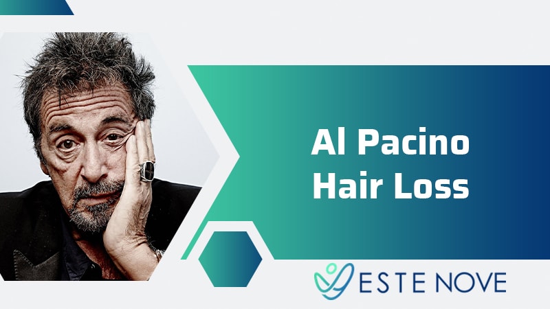 Al Pacino Hair Loss