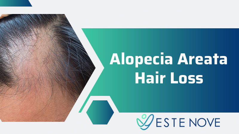 Alopecia Areata Hair Loss - Estenove