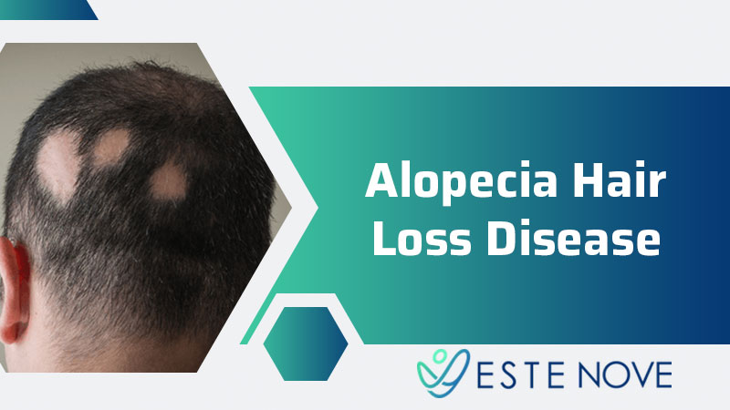 Alopecia Hair Loss Disease