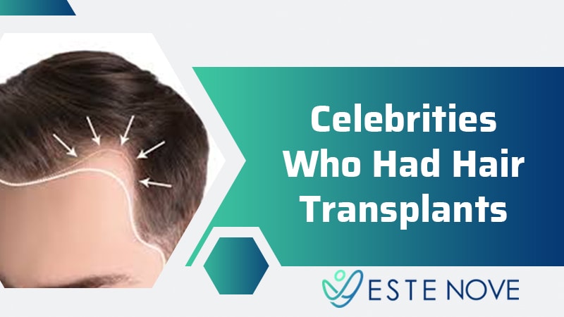 Celebrities Who Had Hair Transplant