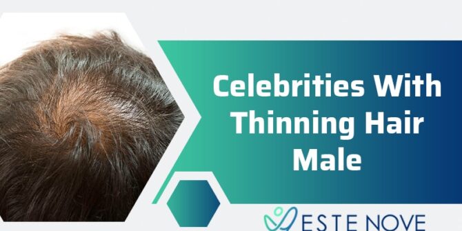 Celebrities With Thinning Hair Male