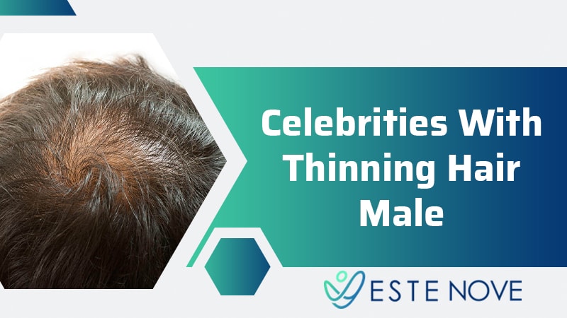 Celebrities With Thinning Hair Male