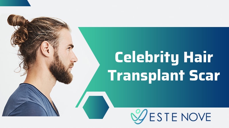 Celebrity Hair Transplant Scar