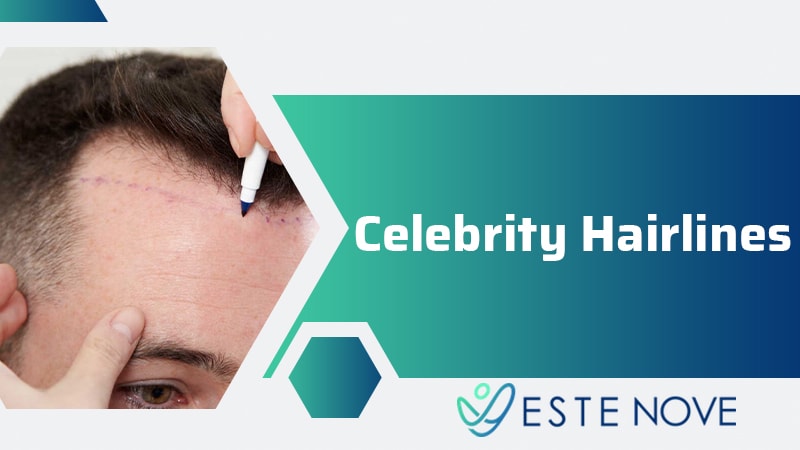 Celebrity Hairlines