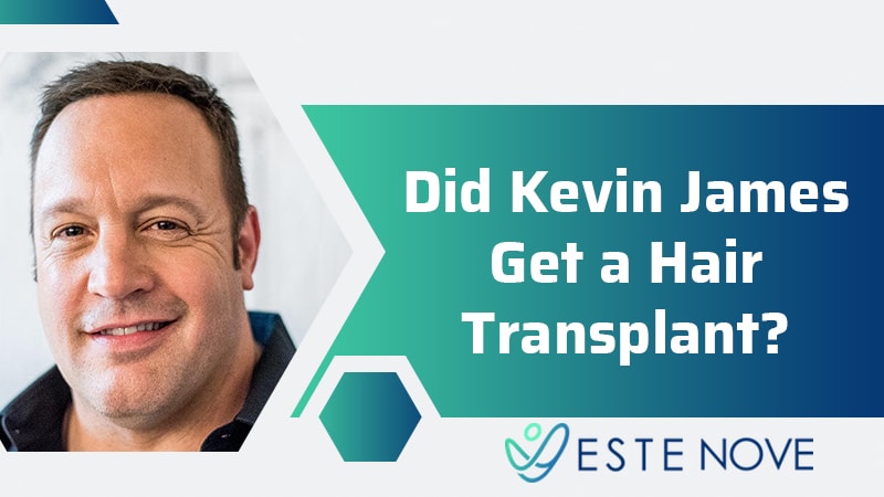 Did Kevin James Get Hair Transplantation?