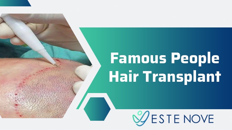 Famous People Hair Transplant