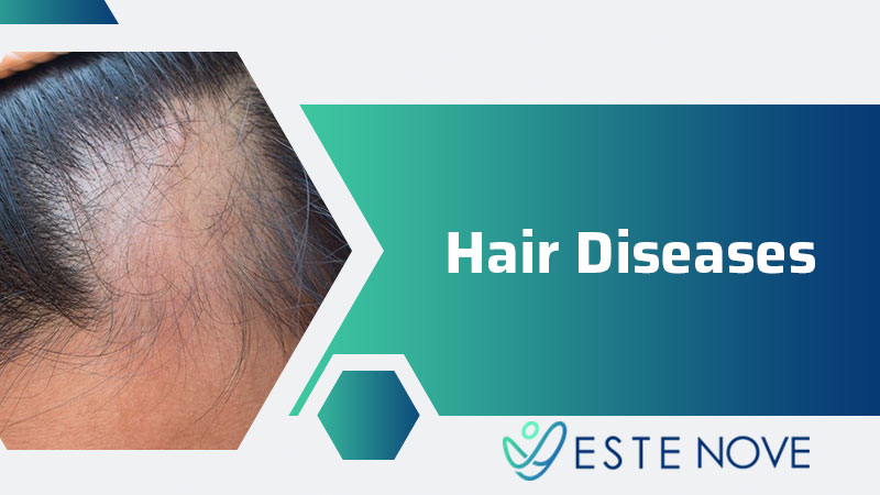 Hair Diseases