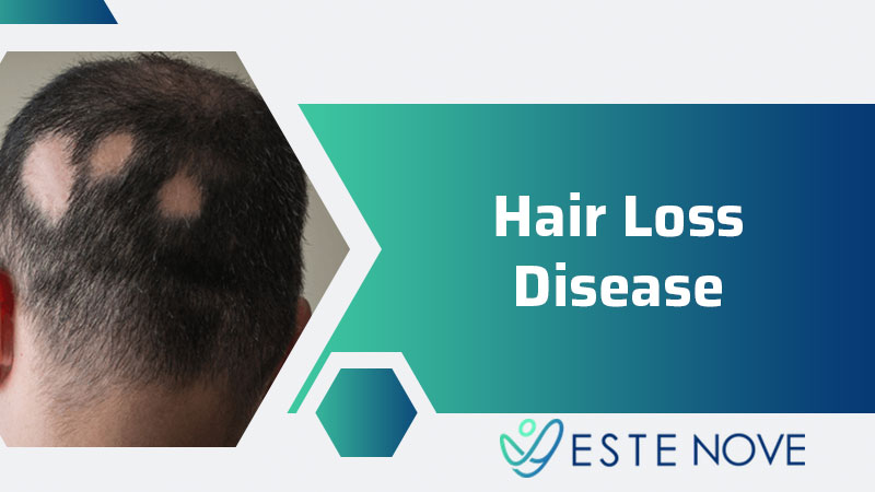 Hair Loss Disease