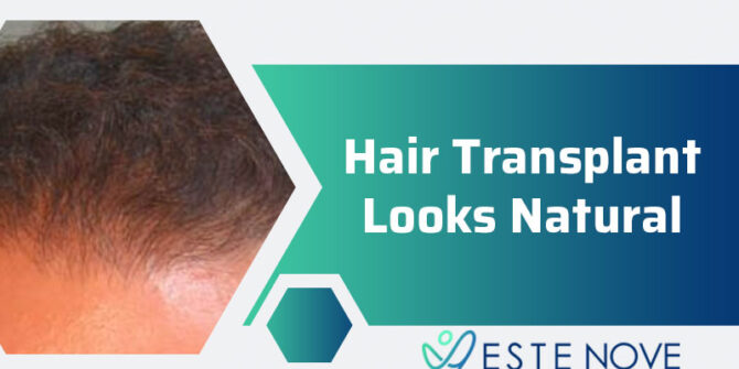 Hair Transplant Looks Natural