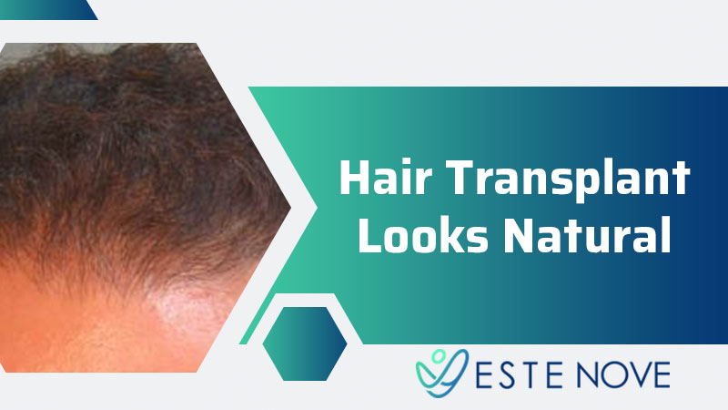 Hair Transplant Looks Natural