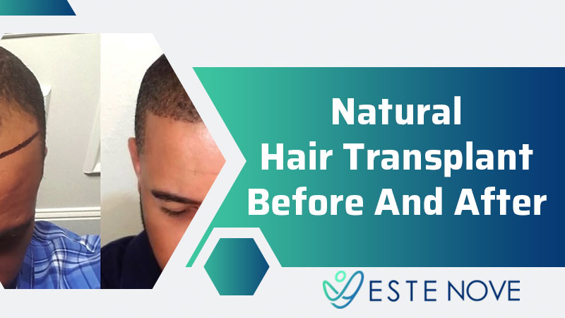 Natural Hair Transplant Before and After - Estenove