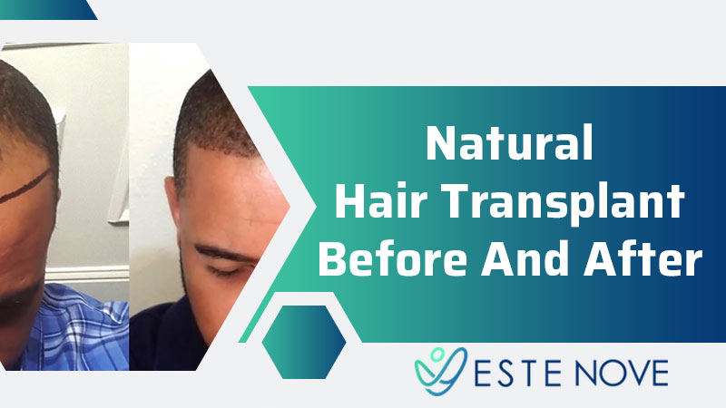 Natural Hair Transplant Before and After - Estenove Natural Hair Transplant Before and After - Estenove