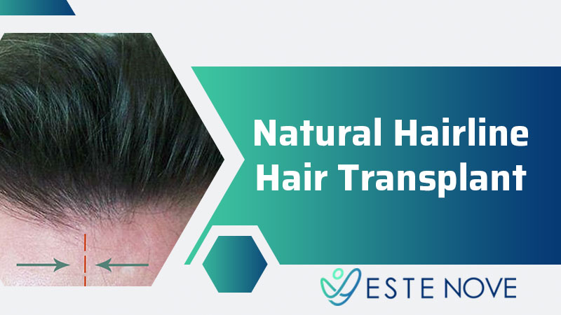 Natural Hairline Hair Transplant