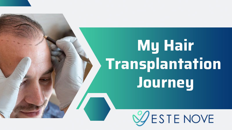 My Hair Transplantation Journey