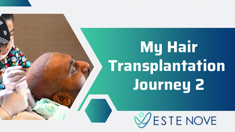 My Hair Transplantation Journey