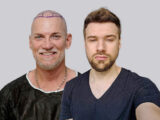 Best Age For A Hair Transplant