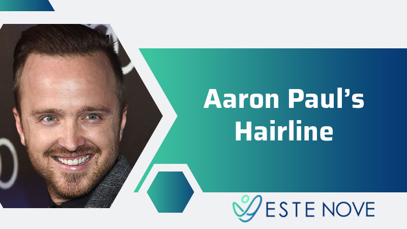 Aaron Paul’s Hairline