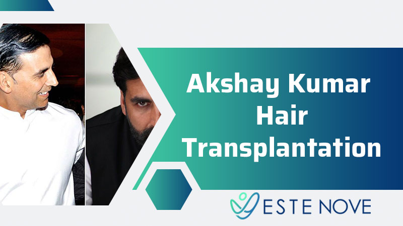 Akshay Kumar Hair Transplantation