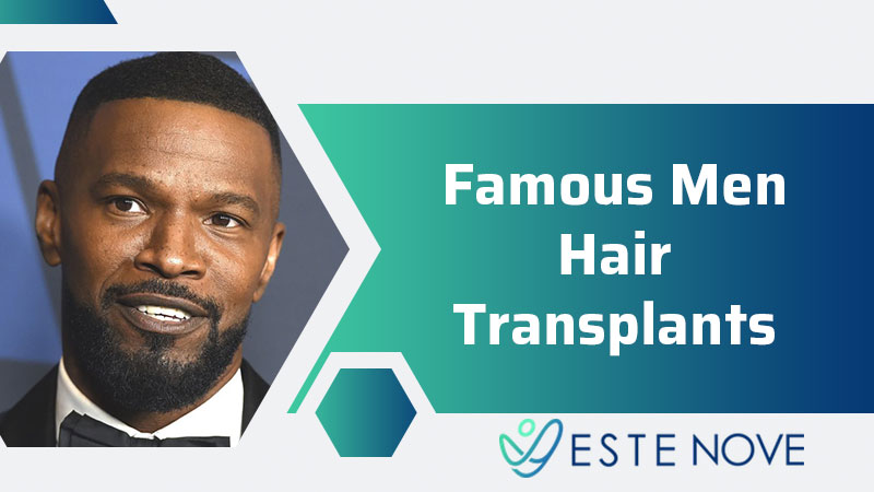 Famous Men Hair Transplants