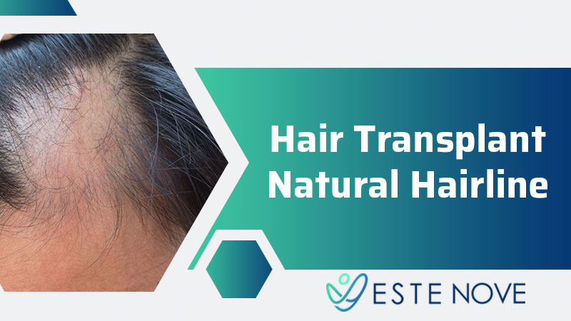 Hair Transplant Natural Hairline - Estenove